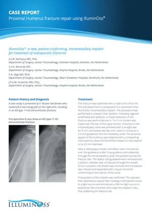 Proximal Humerus fracture repair using IlluminOss (900482)