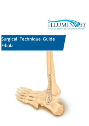 Surgical Technique Guide Fibula (900602)