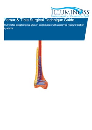 Femur and Tibia Surgical Technique Guide