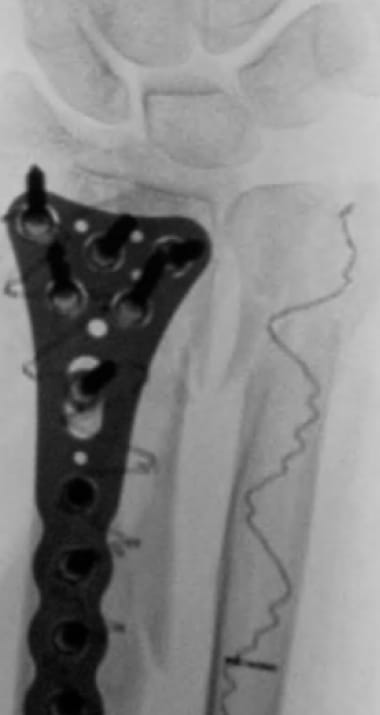X-ray of bone