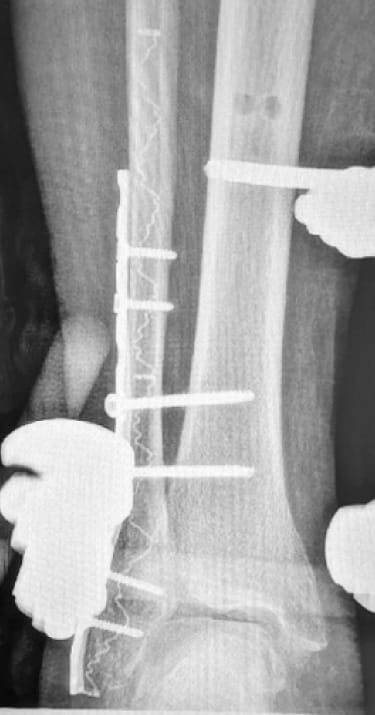 X-ray of bone