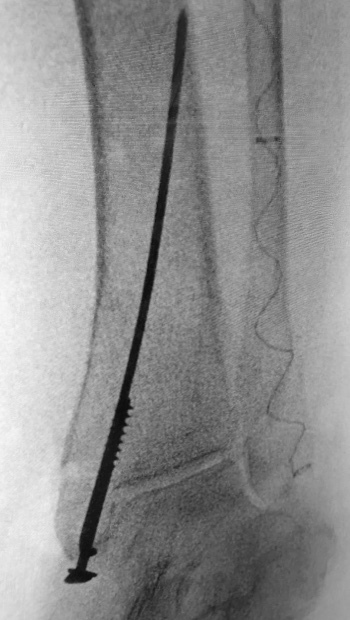 Fibula Fractured X-ray with Implant