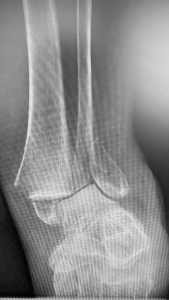 Fibula Fractured X-ray