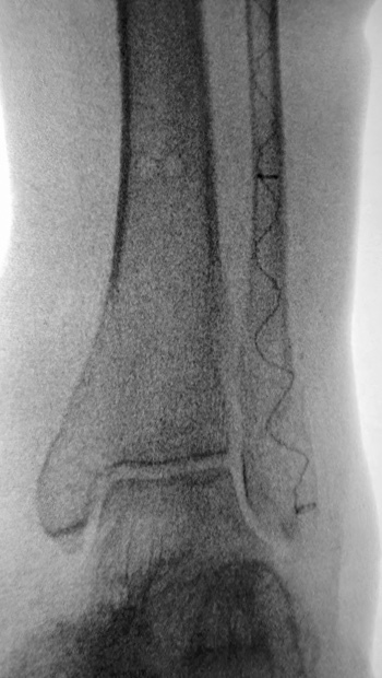 Fibula Fractured X-ray with implant