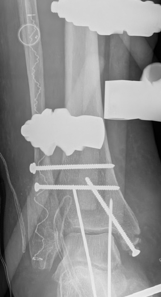 Implant & Bone X-Ray